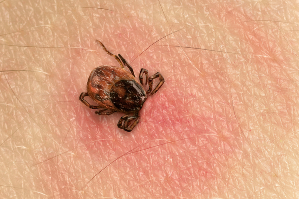 A tick burrows into a person's skin creating a red ring.